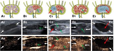 Value of Contrast-Enhanced Ultrasound for Evaluation of Cervical Lymph Node Metastasis in Papillary Thyroid Carcinoma